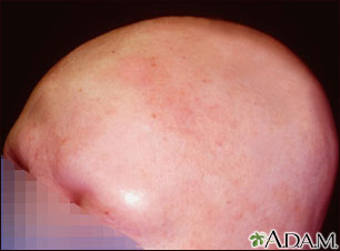 Alopecia total - vista frontal de la cabeza