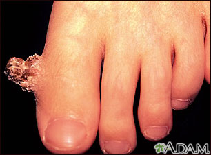 Verruga con un cuerno cutáneo en el dedo del pie