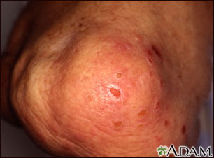 Dermatitis - herpetiforme en la rodilla