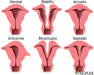 Anomalías uterinas congénitas