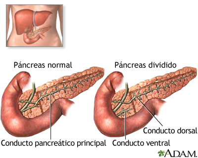 Páncreas dividido
