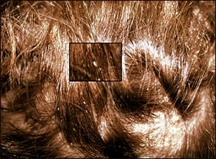Piojos de la cabeza - primer plano de liendres en el cabello