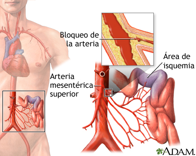 Isquemia e infarto de las arterias mesentéricas