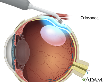 Procedimiento, parte 3