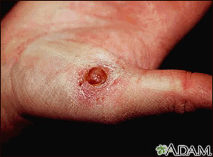 Granuloma piogénico en la mano