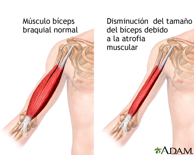 Atrofia muscular