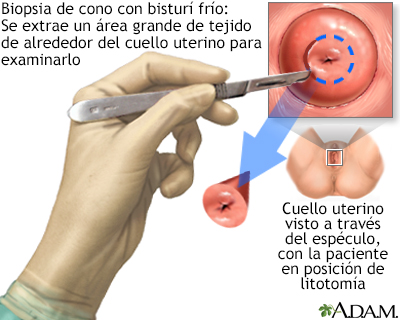 Biopsia de cono con bisturí frío