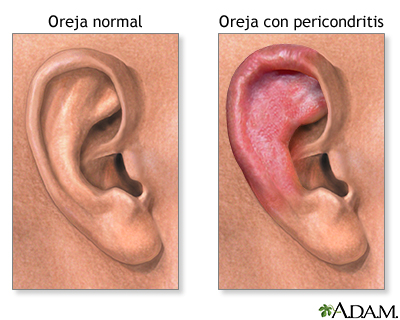 Pericondritis