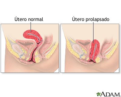 Prolapso uterino