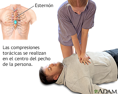 Continúe con las compresiones torácicas