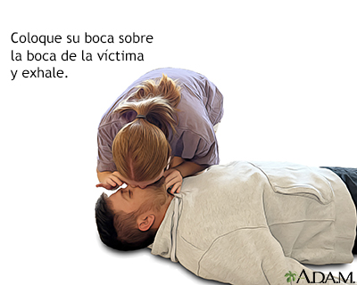 Persona que no respira o tiene dificultad para respirar