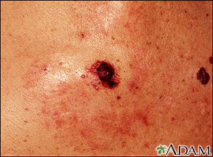 Cáncer de piel - primer plano del melanoma de nivel IV