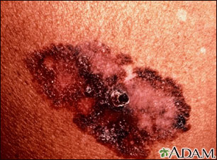 Cáncer de piel - melanoma de propagación superficial