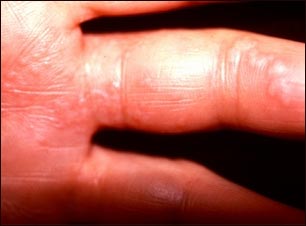 Herpes zoster (culebrilla) la mano MedlinePlus enciclopedia médica illustración