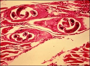Trichinella spiralis en el músculo humano