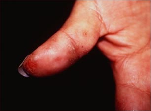 Dermatitis herpetiforme en el pulgar