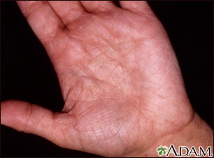Hiperlinearidad de la dermatitis atópica
