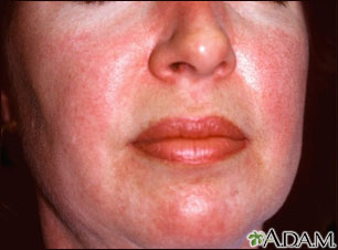 Dermatomiositis - erupción heliotrope en la cara