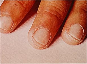 Enfermedad de Kawasaki - exfoliación de las puntas de los dedos
