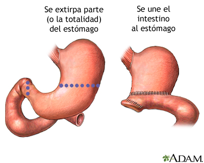 Gastrectomia