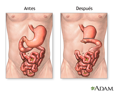 Antes y después de la gastrectomía
