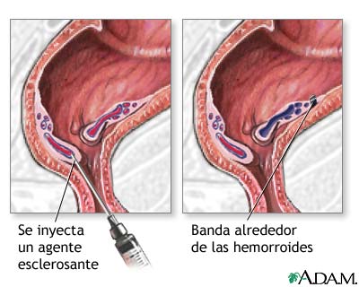 Recurso gatear período Cirugía de hemorroides - Serie—Procedimiento: MedlinePlus enciclopedia  médica