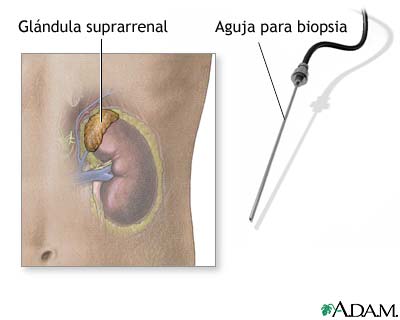 Biopsia de una glándula suprarrenal