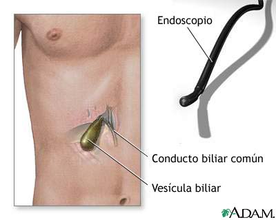 Endoscopia de vesícula biliar