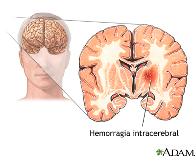 Hemorragia intracerebral