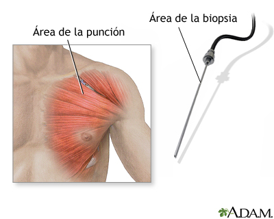 Biopsia muscular