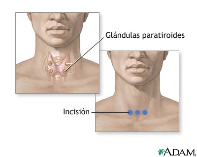 Biopsia de paratiroides
