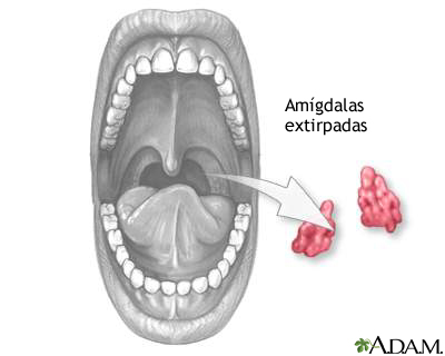 Amigdalectomía: MedlinePlus médica
