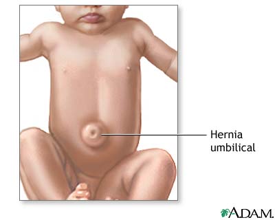 Hernia umbilical