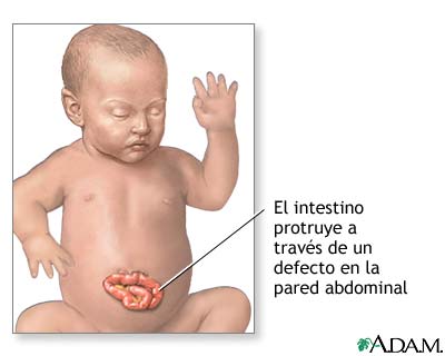 Hernia abdominal infantil (gastrosquisis)