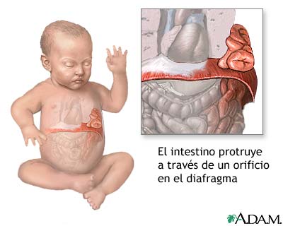 Hernia diafragmática infantil