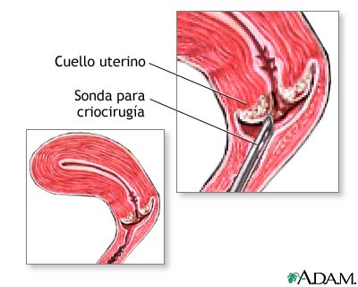 Criocirugía cervical