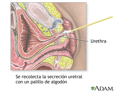 Tinción de Gram de la secreción uretral