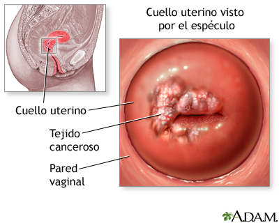 Frotis de Papanicolaou y cáncer cervical