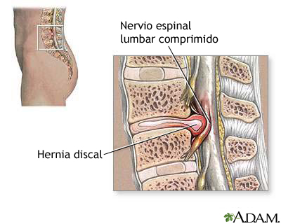 Disco lumbar herniado