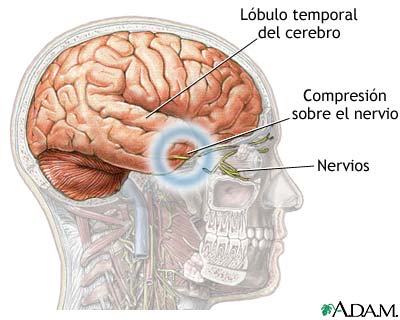 Hernia cerebral