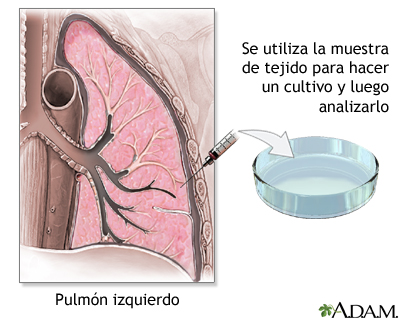 Biopsia de tejido pulmonar