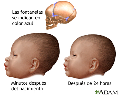 Amoldamiento de cabeza del recién nacido