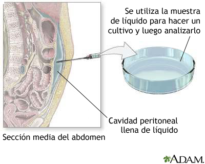 Cultivo peritoneal