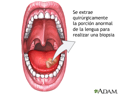 Biopsia lingual