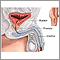 Prostatectomía - serie - Anatomía normal