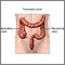 Resección del intestino grueso - Serie