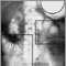 Ileo - Radiografía del estómago e intestino distendido