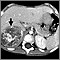 Tomografía computarizada de neuroblastoma en el hígado