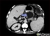 Seudoquiste pancreático - Tomografía computarizada