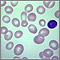 Anemia megaloblástica - Vista de los glóbulos rojos sanguíneos